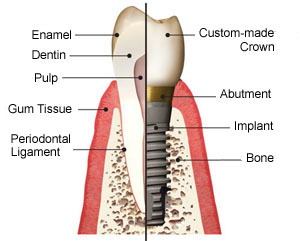 Tooth vs Implant